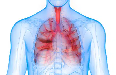 COPD lungs inflamed