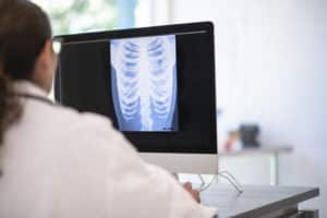 Five Risk Factors of Lung Cancer
